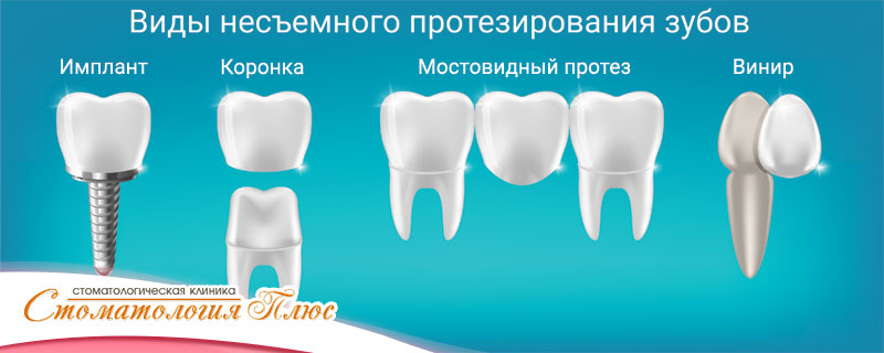 Виды несъемного протезирования